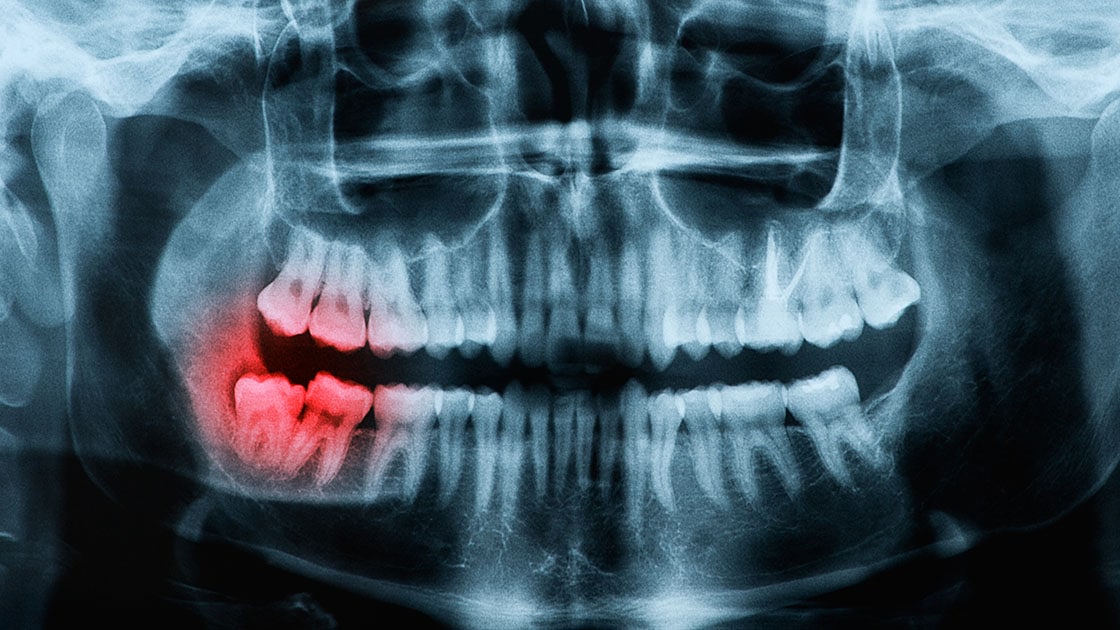 Impacted Tooth & Tooth Exposure